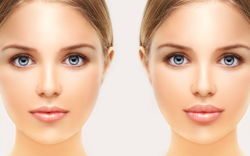 Read more about the article Lip Filler vs Lip Injections: Best Augmentation [2024]