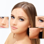 What Chemical Peel Is Best for Acne Scars? Top Choice
