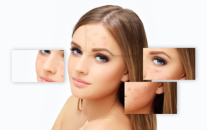 Read more about the article What Chemical Peel Is Best for Acne Scars? Top Choice