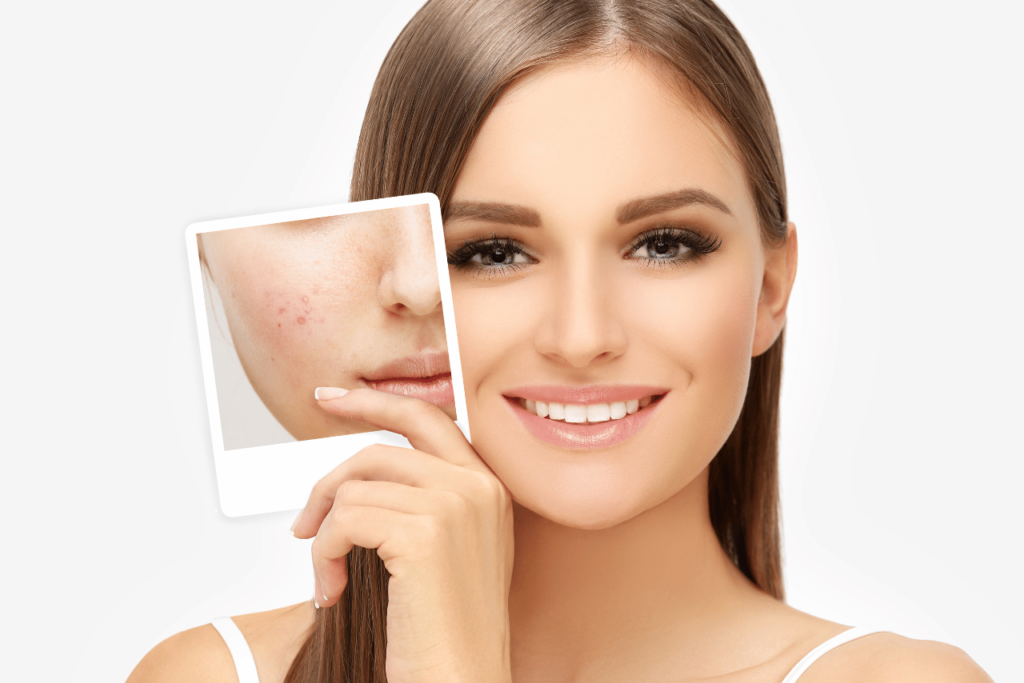 Microneedling benefits: shrinks acne scars.